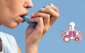 Asthma Relief Natural Package; Dozi ya Mwezi 1